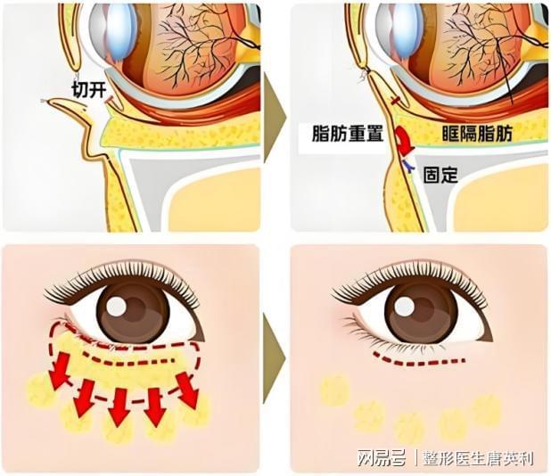 什么是眶隔释放——科普篇j9平台整形医生唐英利：(图2)